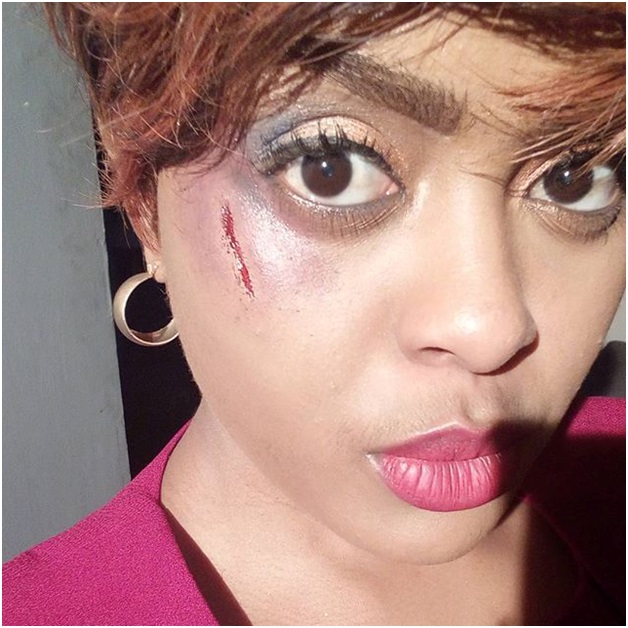 AVRILS life crumbles as she is beaten and bruised in the face. See her photo